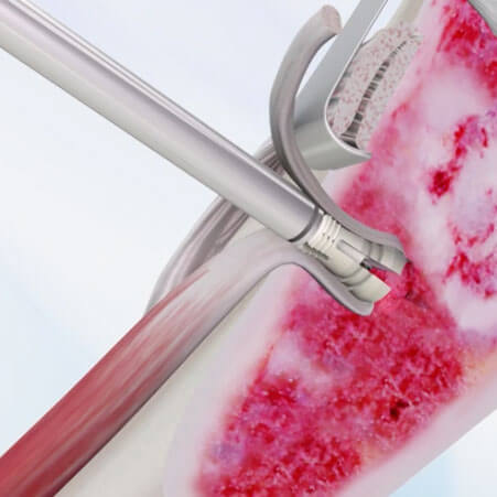 TenoLok's Dual Fixation