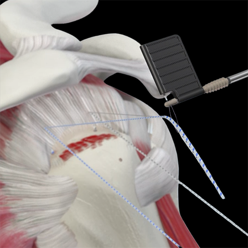 animation of knotless anchor securing sutures through tendon