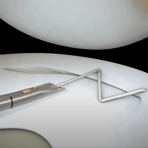 animation of meniscal repair device creating a configuration of stitches over a tear