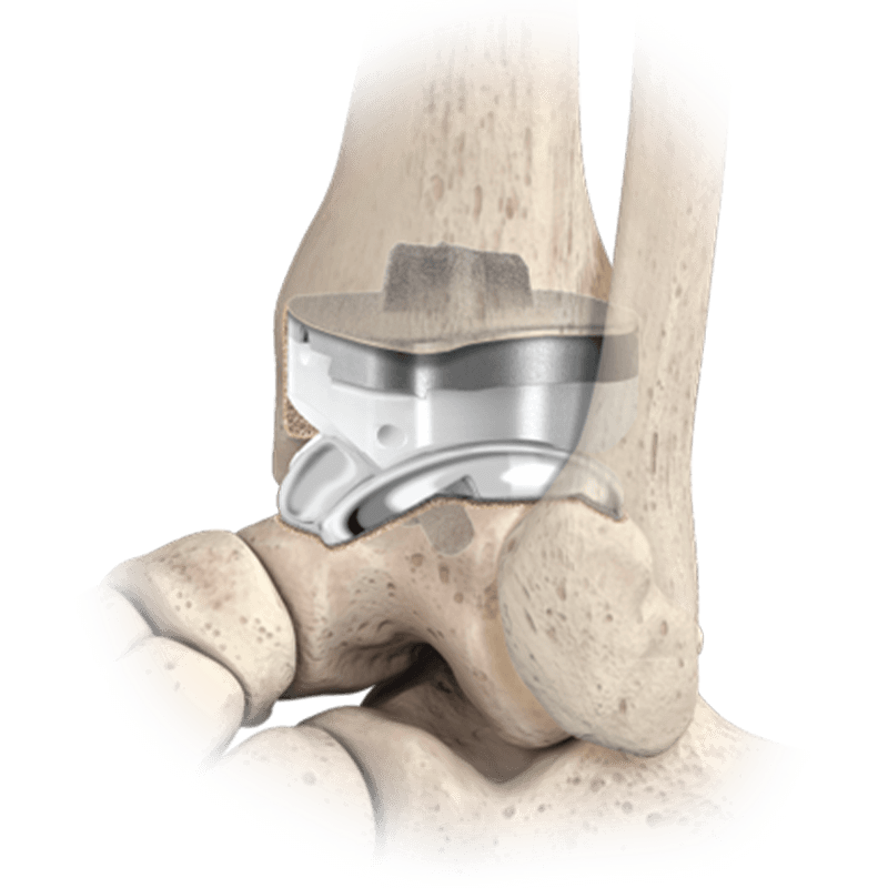 quantum total ankle system placed in ankle bone