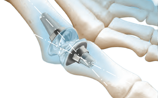 RTS Erste broachlose Implantation