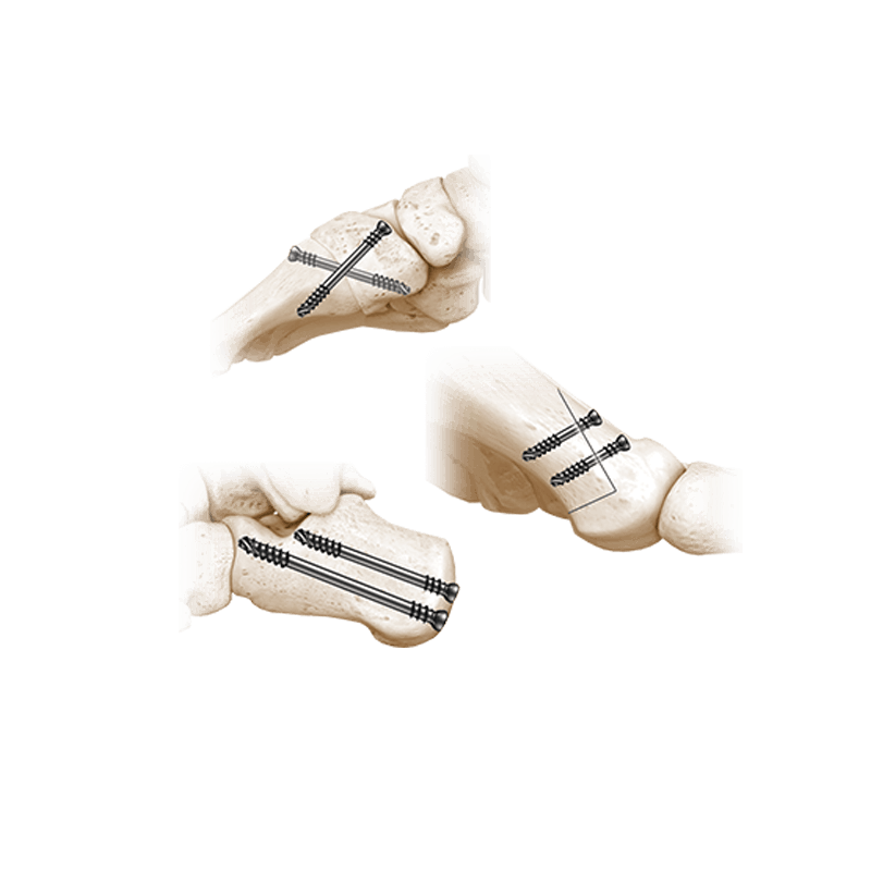 CoLag<sup>®</sup> Compression Screws