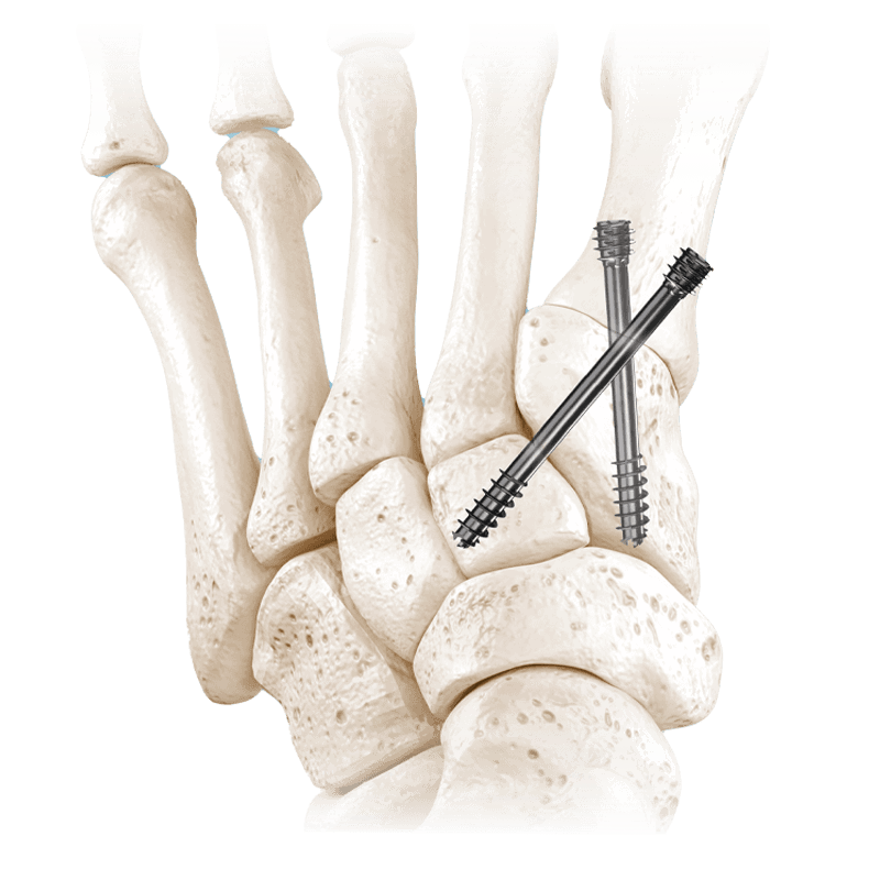 ibs compression screws in-joint