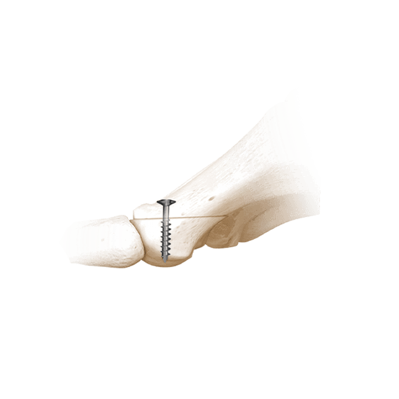 I.B.S.™ Snap-Off Screws