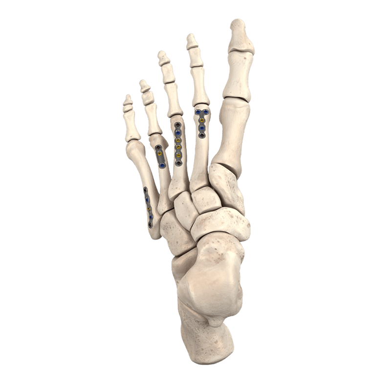 CoLink<sup>®</sup> Mini Dynamic Compression Plating System