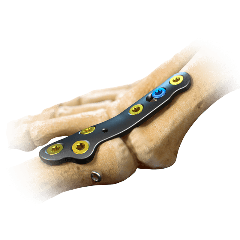 CoLink<sup>®</sup> PCR Carbon Fiber Plating System