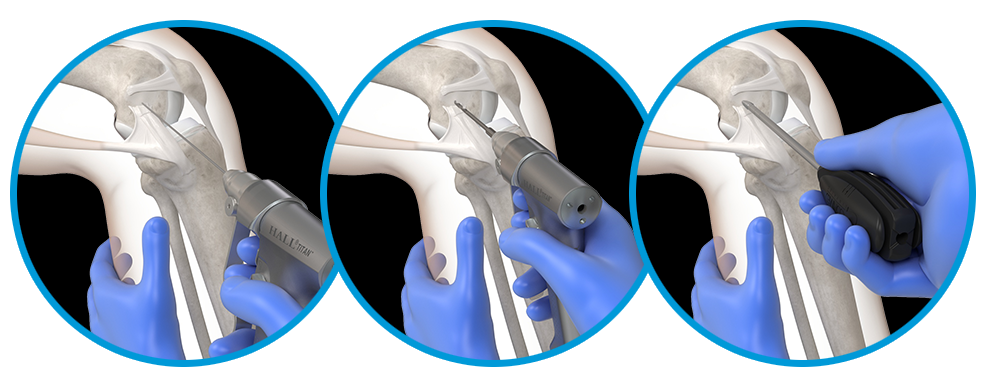 Identify femoral and tibial insertion sites and prepare femoral pilot hole with guide pin, 5.0 mm cannulated reamer to 25 mm, and 5.5 mm hard bone tap.
