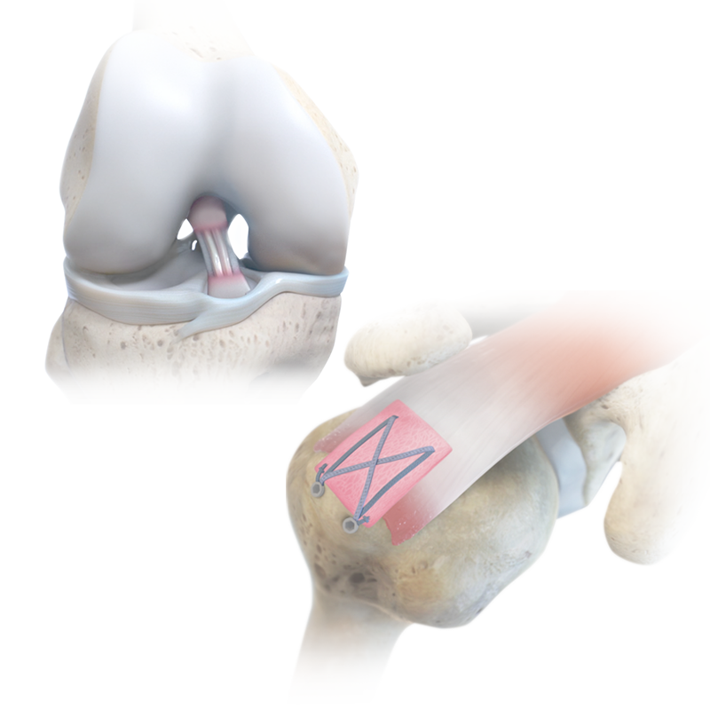 animation of shoulder bone and biobrace implant