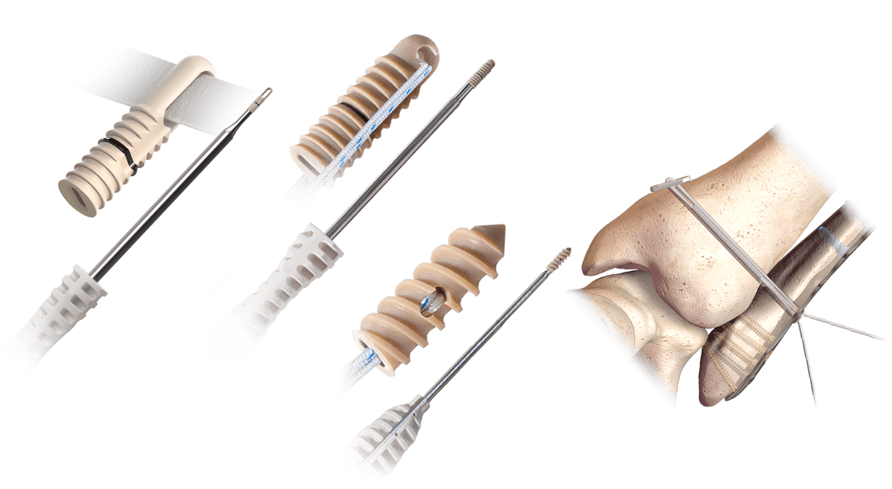 Colección de productos Hercules FT totalmente roscado, FT sin nudos, sistema de sindesmosis sin nudos y XE