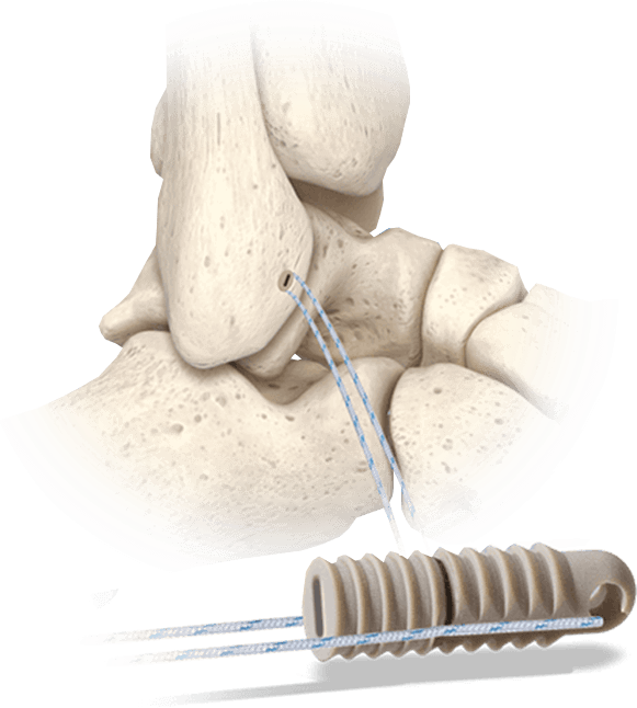 Hercules FT Diagrama sin nudos