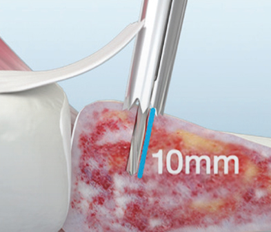 TruShot illustration of the 10mm drill depth