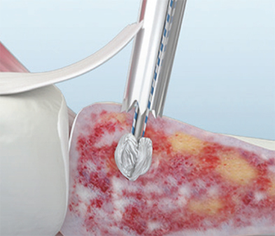 TruShot illustration of the Y-Knot Anchor Strong Fixation