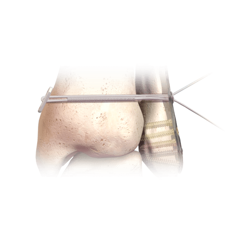 Sistema de implante para sindesmosis sin nudos Hercules<sup>®</sup>
