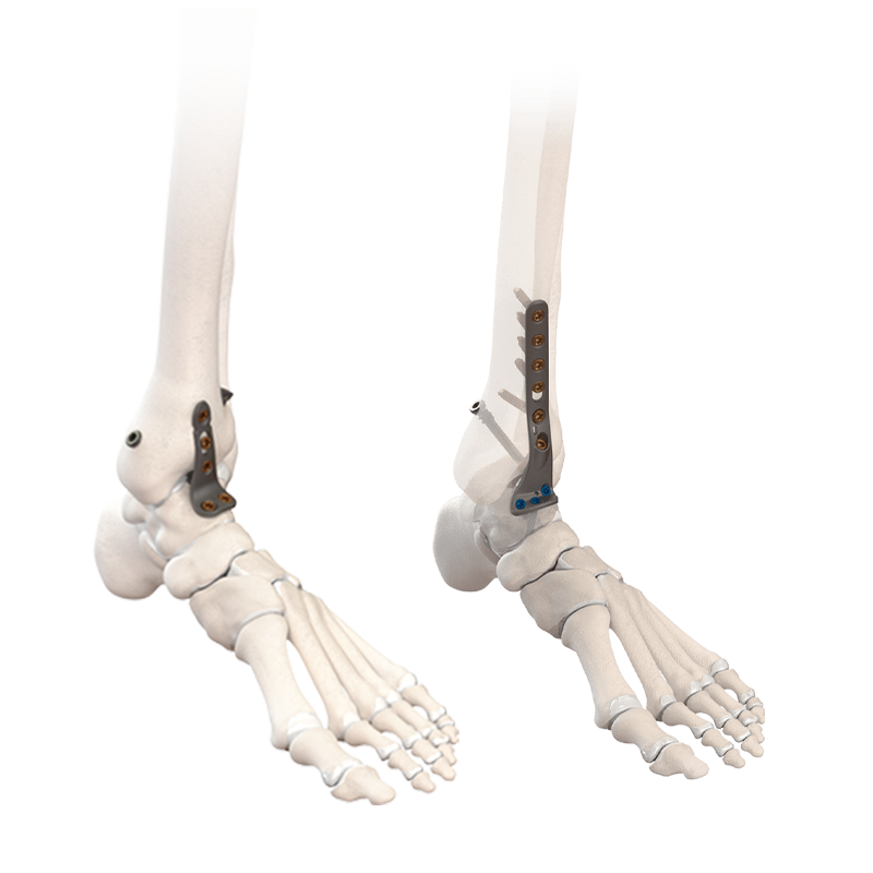 CoLink® NeoFuse Ankle Fusion Plating System