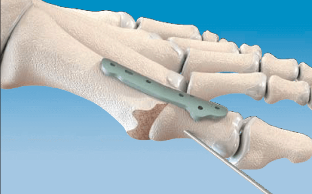 1st MTP Fusion Technique Using the CoLink