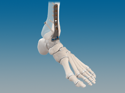  Ankle Fusion Plating Technique Using the CoLink NeoFuse Plating System